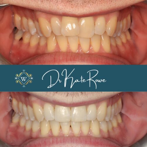 Invisalign results by Dr Kate Rowe at Widcombe Dental Practice