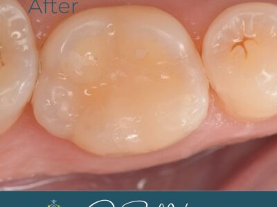 Composite molar filling after treatment at Widcombe Dental Practice