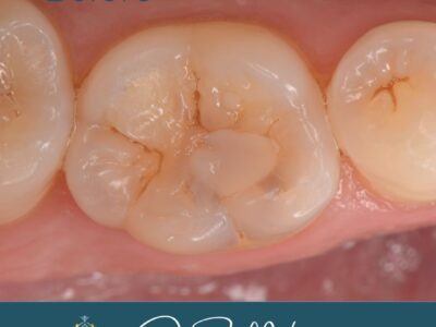 Composite molar filling before treatment at Widcombe Dental Practice