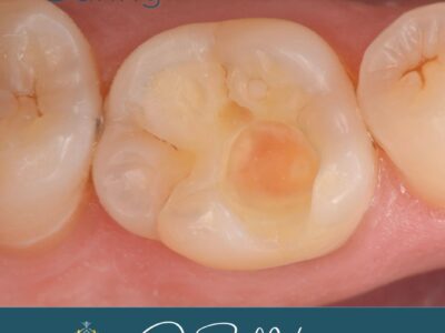 Composite molar filling during treatment at Widcombe Dental Practice