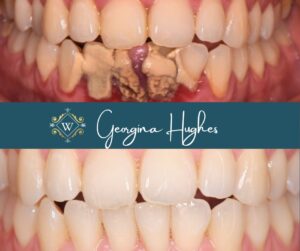 Georgina Hughes dental hygiene calculus build up