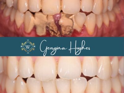 Dental hygiene calculus build up treatment by Georgie Hughes at Widcombe Dental Practice