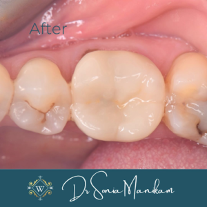 Tooth transformation after treatment at Widcombe Dental Practice