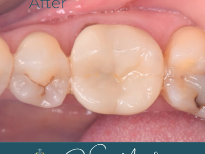 Tooth transformation after treatment at Widcombe Dental Practice