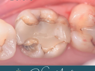 Tooth transformation before treatment at Widcombe Dental Practice