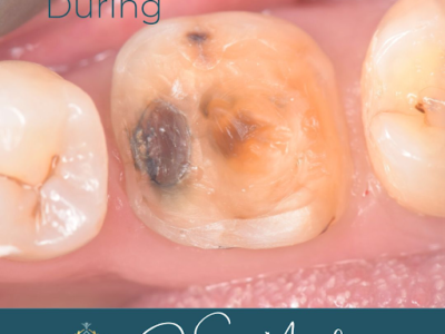 Tooth transformation during treatment at Widcombe Dental Practice