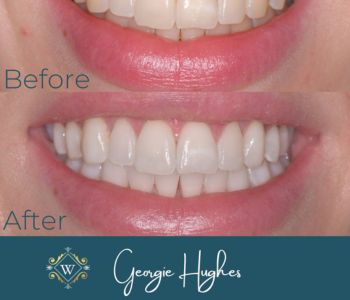 Teeth whitening comparison at Widcombe Dental Practice
