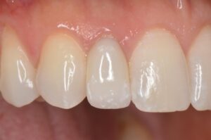 Teeth after dental veneers