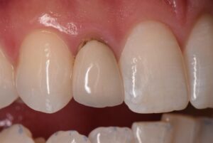 Teeth after dental veneers