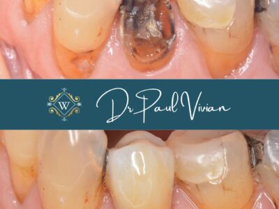 Broken and decayed tooth restoration at Widcombe Dental Practice