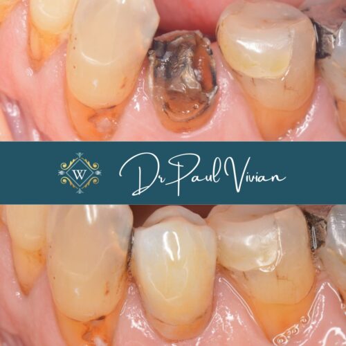 Broken and decayed tooth restoration at Widcombe Dental Practice
