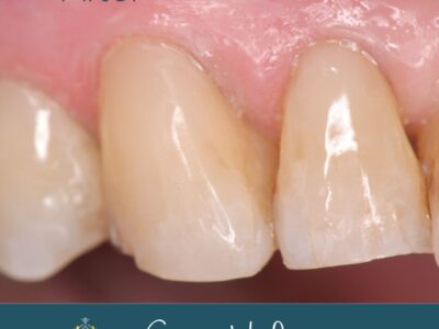 Tooth abrasion treatment after at Widcombe Dental Practice