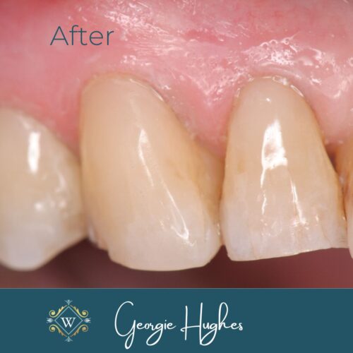 Tooth abrasion treatment after at Widcombe Dental Practice