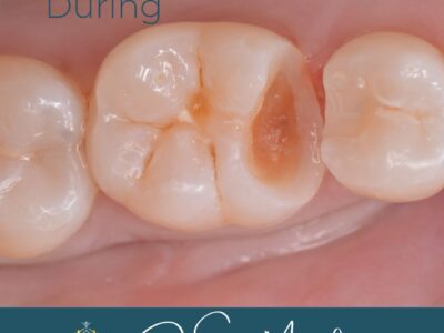 Tooth transformation by Dr Sonia Manikam at Widcombe Dental Practice