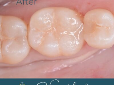 Tooth transformation by Dr Sonia Manikam at Widcombe Dental Practice