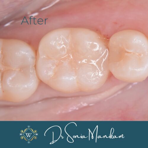 Tooth transformation by Dr Sonia Manikam at Widcombe Dental Practice