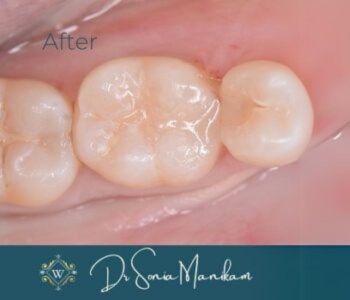 Tooth transformation by Dr Sonia Manikam at Widcombe Dental Practice