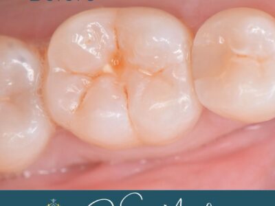 Tooth transformation before by Dr Sonia Manikam at Widcombe Dental Practice
