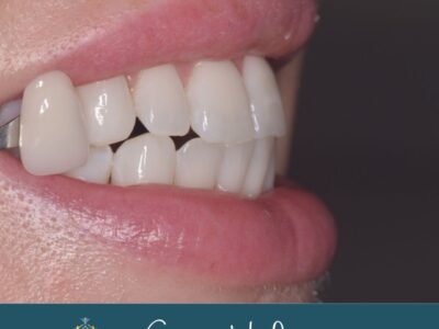Teeth whitening after treatment at Widcombe Dental Practice