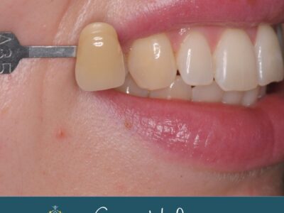 Teeth whitening before treatment at Widcombe Dental Practice