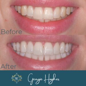 Widcombe Dental Teeth Whitening comparison November