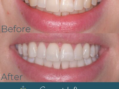 Teeth whitening comparison at Widcombe Dental Practice