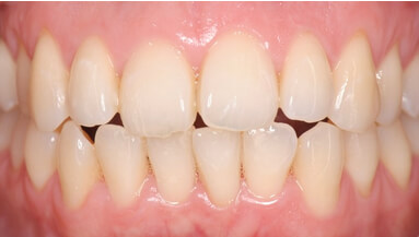 Calculus removal after treatment at Widcombe Dental Practice